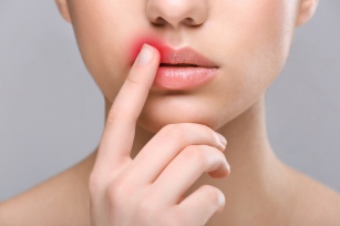 Leczenie opryszczki i zajadów w kącikach ust - jak do tego podejść?