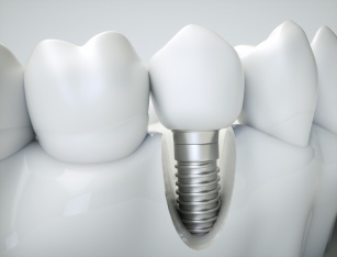 Implanty zębów - rodzaje, trwałość oraz techniki wszczepienia