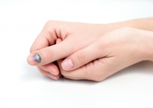 Przebarwienia na paznokciach – co oznaczają?