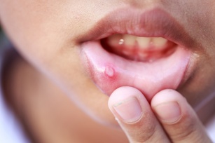 Trzy oblicza zapaleń jamy ustnej u dziecka: afty, pleśniawki i wirusy