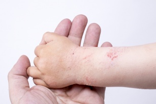 Atopowe zapalenie skóry u dziecka. Jak rozpoznać i leczyć?