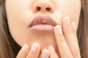 Popękane i spierzchnięte usta -  skuteczne sposoby na regenerację ust