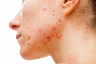 Uczulenie na twarzy – bolączka współczesnych alergików.