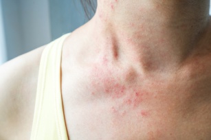 Grzybica skóry gładkiej – objawy, przyczyny, leczenie i zapobieganie nawrotom choroby
