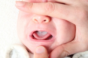 Pleśniawki i afty u niemowląt - objawy i sposoby leczenia